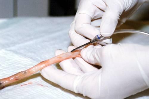 Aus einer Nabelschnur wird Blut für die Gewinnung von Stammzellen entnommen &ndash; sie gelten als wertvoller medizinischer Rohstoff.