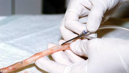 Aus einer Nabelschnur wird Blut für die Gewinnung von Stammzellen entnommen – sie gelten als wertvoller medizinischer Rohstoff. Aus einer Nabelschnur wird Blut für die Gewinnung von Stammzellen entnommen – sie gelten als wertvoller medizinischer Rohstoff.