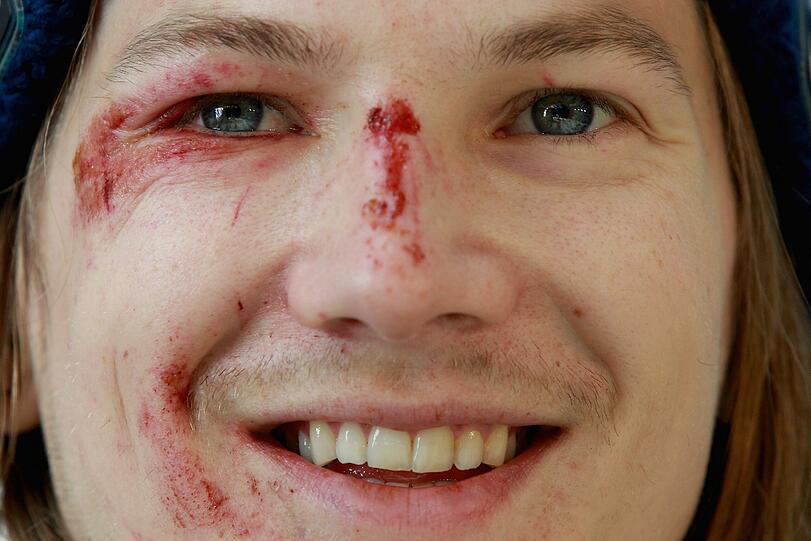 Die Spuren des Horror-Sturzes sind ins Gesicht von Tom Hilde gezeichnet. Doch der Norweger kann schon wieder lachen.