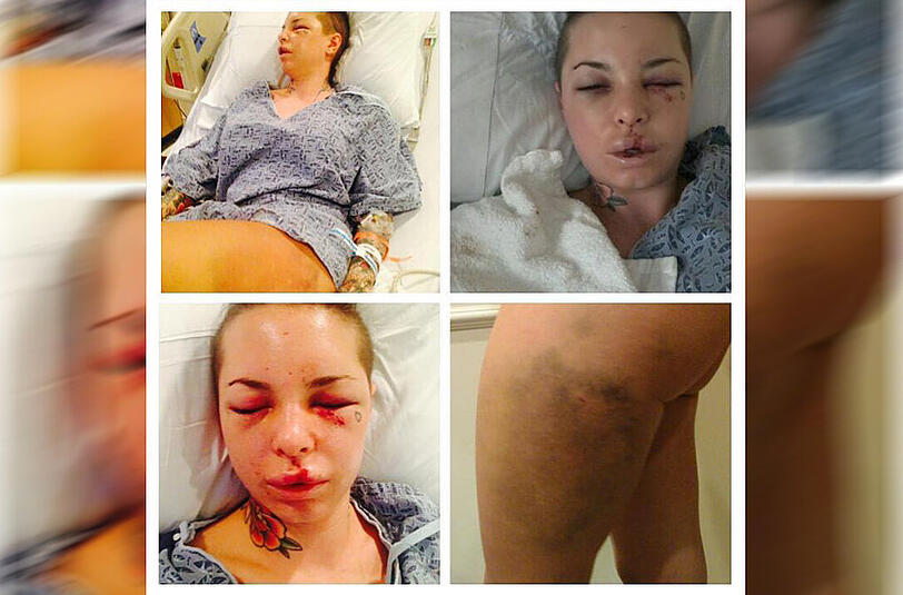 Schock-Fotos aus dem Krankenhaus: Christy Mack ist von ihrem Ex-Freund heftig verprügelt worden.