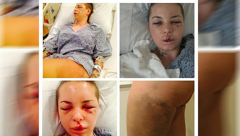 Schock-Fotos aus dem Krankenhaus: Christy Mack ist von ihrem Ex-Freund heftig verprügelt worden. Schock-Fotos aus dem Krankenhaus: Christy Mack ist von ihrem Ex-Freund heftig verprügelt worden.