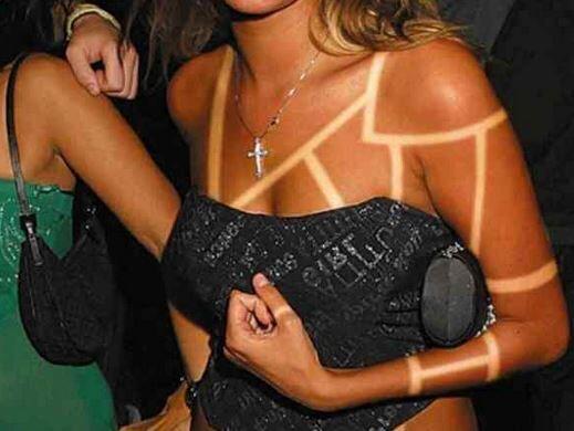 Der #sunburnart-Trend verbreitet sich auf Twitter rasend schnell. Hautärzte warnen vor den Gefahren.