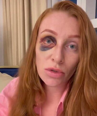 Georgina Fleur meldet sich mit blauem Auge bei ihren Fans Georgina Fleur meldet sich mit blauem Auge bei ihren Fans