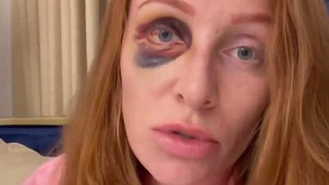 Georgina Fleur meldet sich mit blauem Auge bei ihren Fans