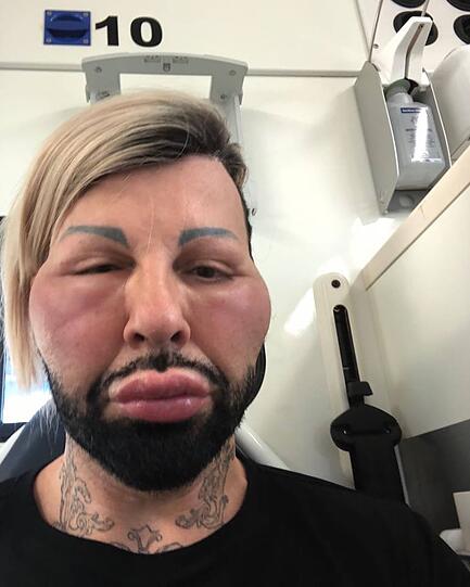 Allergische Reaktion: Harald Glööckler musste in eine Klinik.