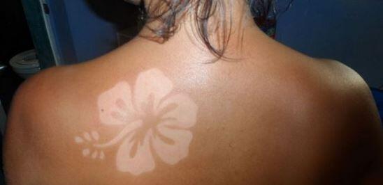 Der #sunburnart-Trend verbreitet sich auf Twitter rasend schnell. Hautärzte warnen vor den Gefahren.