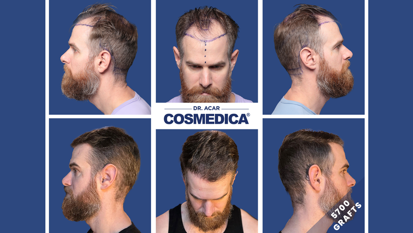 Diese unglaublichen Vorher nachher Ergebnisse können bei einer Haartransplantation in der Türkei erreicht werden.