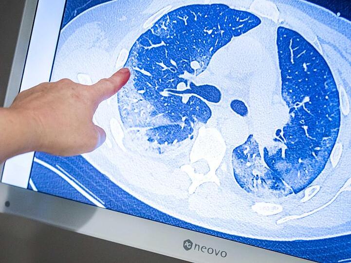 Ein behandelnder Arzt zeigt auf die CT-Aufnahme der Lunge eines Patienten, der sich mit dem Coronavirus infiziert hat.