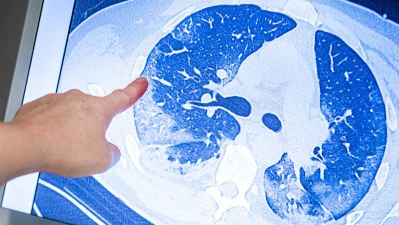 Ein behandelnder Arzt zeigt auf die CT-Aufnahme der Lunge eines Patienten, der sich mit dem Coronavirus infiziert hat. Ein behandelnder Arzt zeigt auf die CT-Aufnahme der Lunge eines Patienten, der sich mit dem Coronavirus infiziert hat.