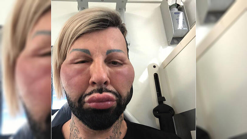 Dieses Foto macht sprachlos! Star-Designer Harald Glööckler postete im Juli mehrere Bilder, die ihn mit angeschwollenem Gesicht zeigten. Er erlitt einen Allergie-Schock! "Als der Hals anschwoll und das Kinn plötzlich doppelt so dick war, dachte ich, jetzt wird's schwierig. Ich bin nicht so, dass ich immer gleich einen Arzt rufe, aber das war der Moment, in dem ich dachte, jetzt rufst du besser mal Hilfe." Ein Notarzt brachte den Designer schließlich ins Krankenhaus. Nach mehreren Infusionen gingen die Schwellungen zurück.