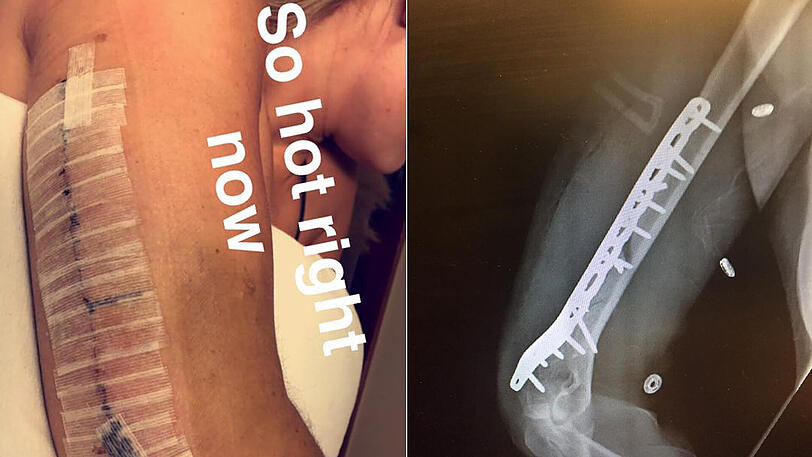 Die Röntgenbilder vom verletzten Arm...