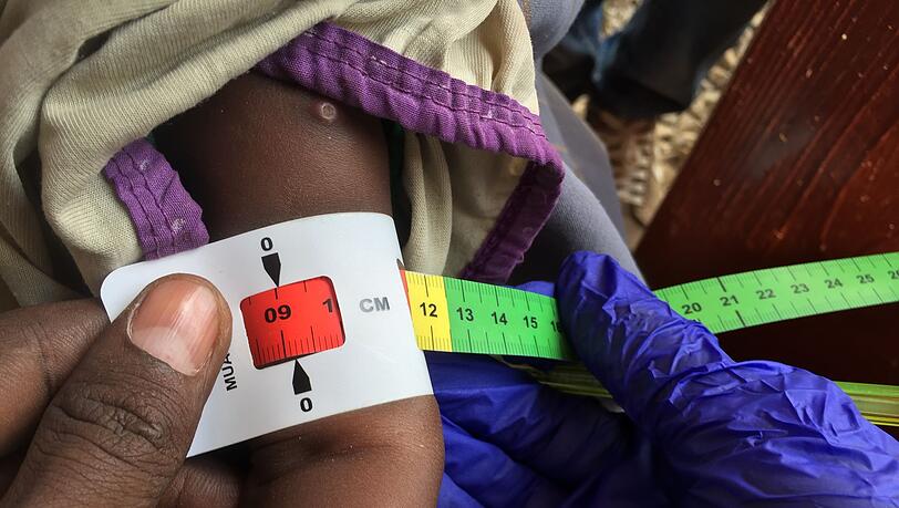 Der Armumfang eines schwer unterernährten Babys in Somalia wird gemessen. (Archivbild)