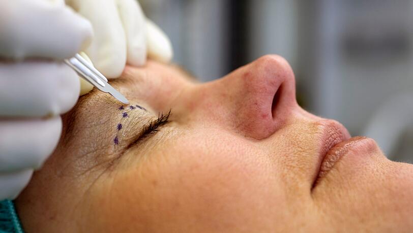 Ein Schönheitschirurg setzt das Skalpell an einer zuvor markierten Stelle am Augenlid einer Patientin an, um eine Augenlidstraffung durchzuführen. (Symbolbild) Ein Schönheitschirurg setzt das Skalpell an einer zuvor markierten Stelle am Augenlid einer Patientin an, um eine Augenlidstraffung durchzuführen. (Symbolbild)