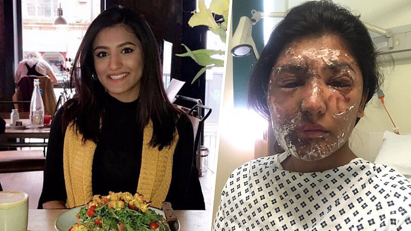 Die knapp 21-jährige Resham Khan vor und nach der Säureattacke.