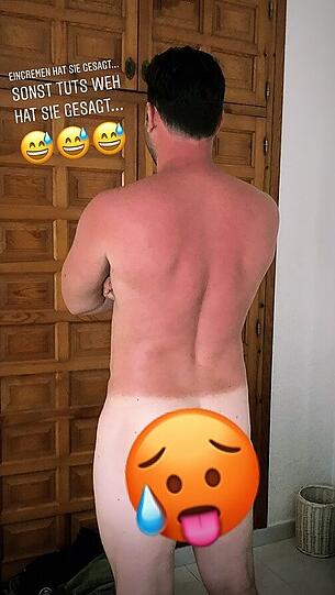 Autsch! Der Rücken von Ex-Bachelor Daniel Völz dürfte mit diesem Sonnenbrand bestimmt brennen.