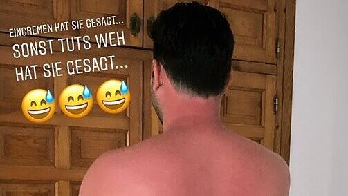 Autsch! Der Rücken von Ex-Bachelor Daniel Völz dürfte mit diesem Sonnenbrand bestimmt brennen. Autsch! Der Rücken von Ex-Bachelor Daniel Völz dürfte mit diesem Sonnenbrand bestimmt brennen.