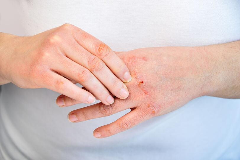 Beanspruchte Hände lassen sich mit Kartoffelwasser verwöhnen. Dafür bereitet man ein Handbad aus lauwarmem Kartoffelwasser vor und lässt die Hände dort fünf bis zehn Minuten einweichen. Nach der Kartoffelwasser-Kur die Hände sanft trockentupfen und mit einer pflegenden Handcreme eincremen. Beanspruchte Hände lassen sich mit Kartoffelwasser verwöhnen. Dafür bereitet man ein Handbad aus lauwarmem Kartoffelwasser vor und lässt die Hände dort fünf bis zehn Minuten einweichen. Nach der Kartoffelwasser-Kur die Hände sanft trockentupfen und mit einer pflegenden Handcreme eincremen.