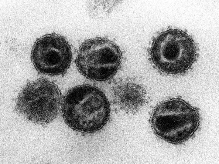 HIV-Viren unter einem Elektronenmikroskop.