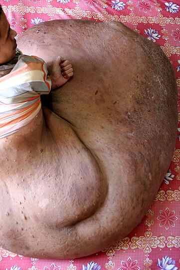 Der krebskranke Vietnamese Nguyen Duy Hai in seinem Haus in Da Lat (Vietnam). Er zeigt seinen 90 Kilogramm schweren Tumor am Bein, der in Vietnam von einem amerikanischen Spezialisten operiert wird.