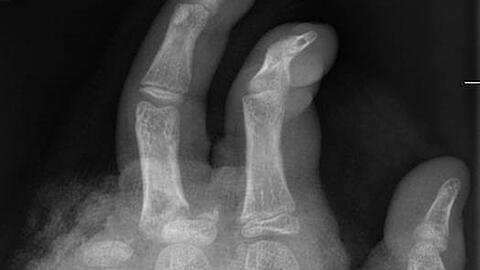 So kann ein R&ouml;ntgenbild nach einer missgl&uuml;ckten B&ouml;llerexplosion aussehen: Zwei Finger fehlen.