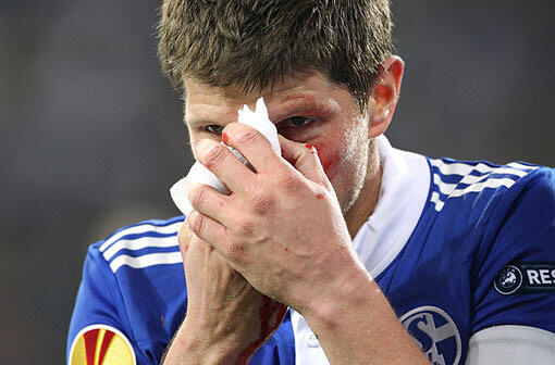 Stürmer Klaas-Jan Huntelaar hat sich beim 0:0 des FC Schalke 04 im Europa-League-Spiel gegen AEK Larnaka am Donnerstag einen Nasenbeinbruch zugezogen.