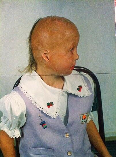 Valentina als Kind und heute: Haut und Haare auf der rechten Kopfseite sind verbrannt, das Gesicht ist mit Narben übersät.