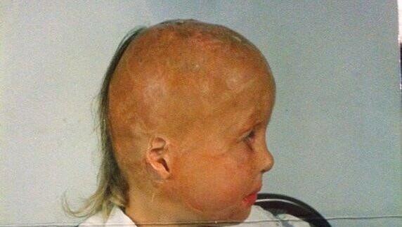 Valentina als Kind und heute: Haut und Haare auf der rechten Kopfseite sind verbrannt, das Gesicht ist mit Narben übersät. Valentina als Kind und heute: Haut und Haare auf der rechten Kopfseite sind verbrannt, das Gesicht ist mit Narben übersät.