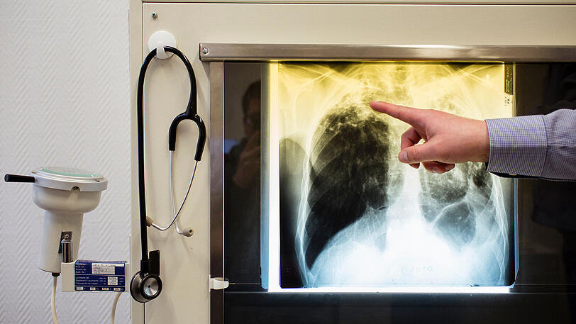 Ein Arzt zeigt einen Tuberkulose-Fall anhand eines Röntgenbildes. Jährlich sterben Millionen Menschen an der Lungenkrankheit.