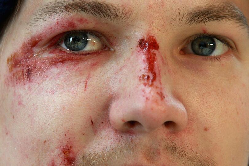 Die Spuren des Horror-Sturzes sind ins Gesicht von Tom Hilde gezeichnet. Doch der Norweger kann schon wieder lachen.