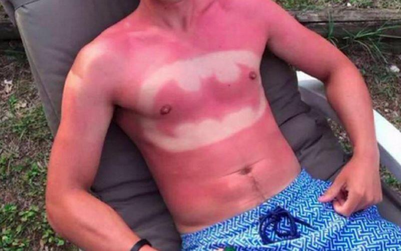 Der #sunburnart-Trend verbreitet sich auf Twitter rasend schnell. Hautärzte warnen vor den Gefahren.