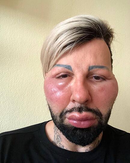 Allergische Reaktion: Harald Glööckler musste in eine Klinik.