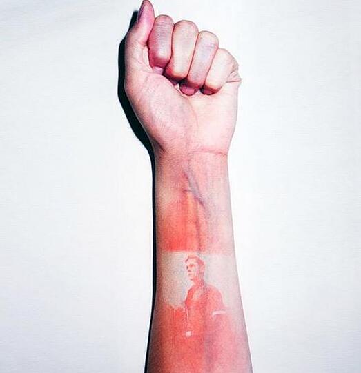 Der #sunburnart-Trend verbreitet sich auf Twitter rasend schnell. Hautärzte warnen vor den Gefahren.