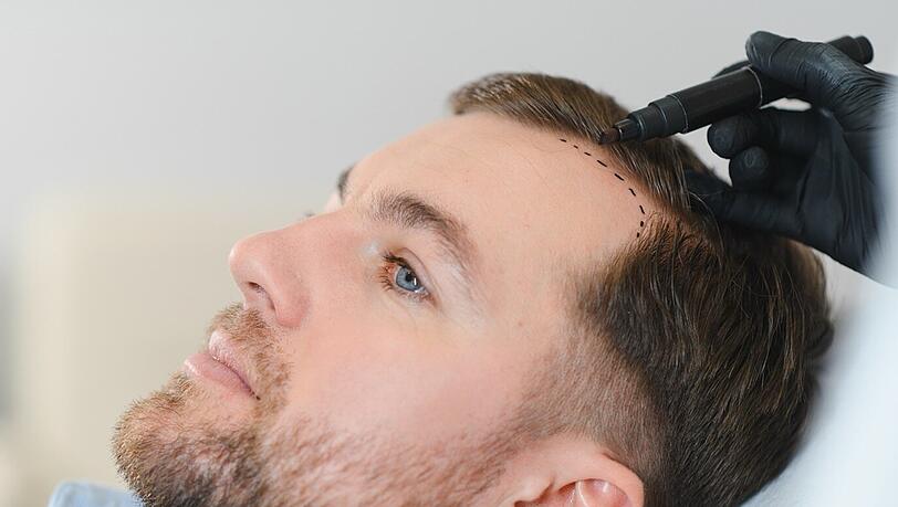 Beratung in Deutschland für eine Haartransplantation in der Türkei – Effektiv und unverbindlich.