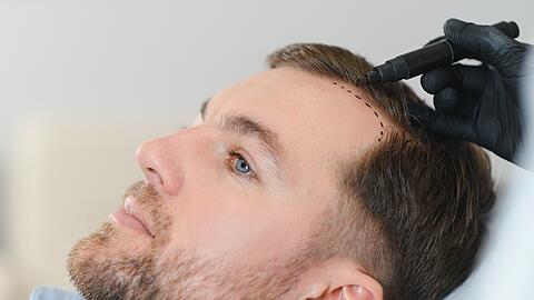 Beratung in Deutschland f&uuml;r eine Haartransplantation in der T&uuml;rkei &ndash; Effektiv und unverbindlich.