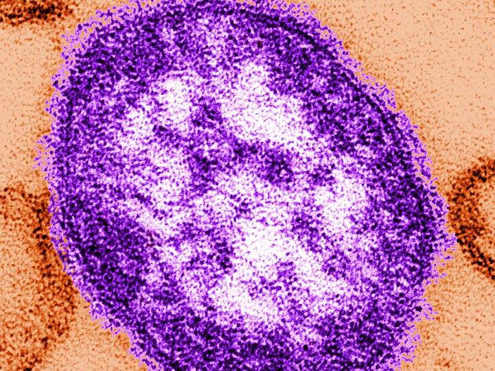 Teile eines Masernvirus: Mit Abstand am schwersten betroffen war die Ukraine mit mehr als 53.000 Fällen.