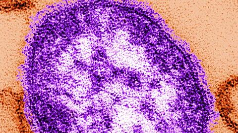 Teile eines Masernvirus: Mit Abstand am schwersten betroffen war die Ukraine mit mehr als 53.000 Fällen.