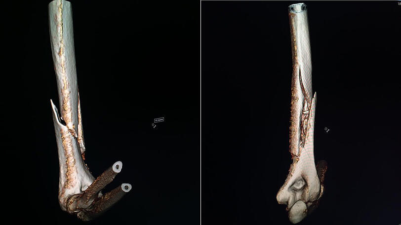 Die Röntgenbilder vom verletzten Arm.