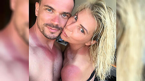Giulia Siegel und ihr Freund Ludwig Heer zeigen ihrer heftigen Sonnenbrand