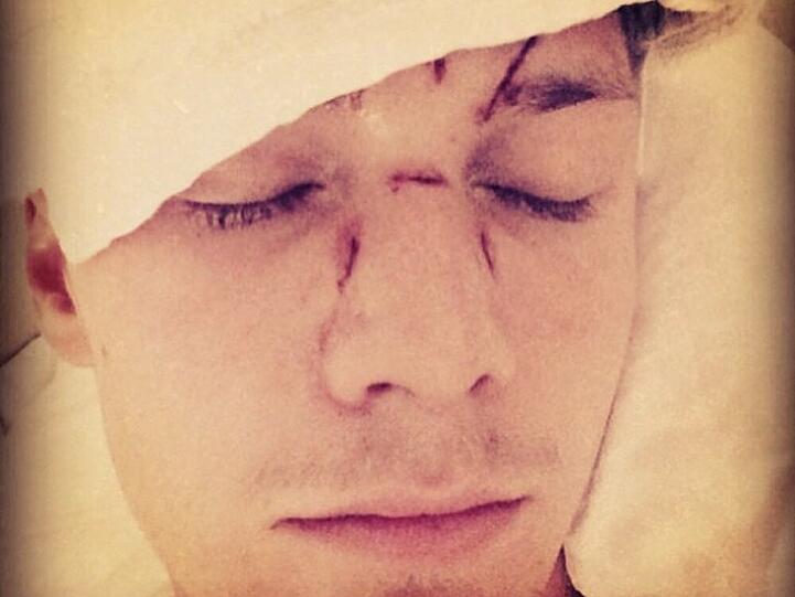 Barron Hilton nach der Prügelei