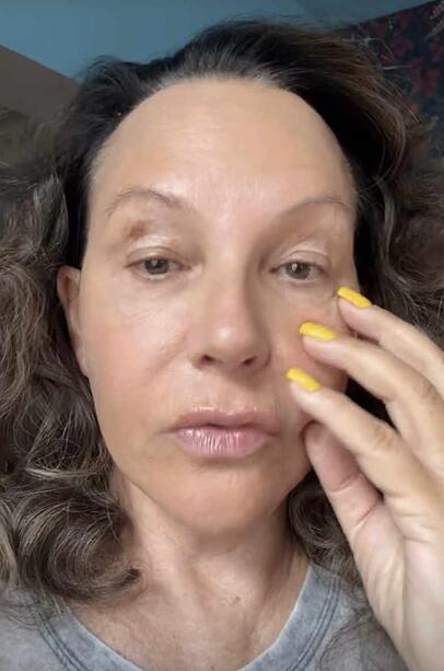 Ohren, Wangen und Kinn sind nach ihrem Beauty-Eingriff noch leicht angeschwollen, wie Natascha Ochsenknecht auf Instagram zeigt. Ohren, Wangen und Kinn sind nach ihrem Beauty-Eingriff noch leicht angeschwollen, wie Natascha Ochsenknecht auf Instagram zeigt.