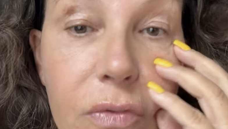 Ohren, Wangen und Kinn sind nach ihrem Beauty-Eingriff noch leicht angeschwollen, wie Natascha Ochsenknecht auf Instagram zeigt. Ohren, Wangen und Kinn sind nach ihrem Beauty-Eingriff noch leicht angeschwollen, wie Natascha Ochsenknecht auf Instagram zeigt.