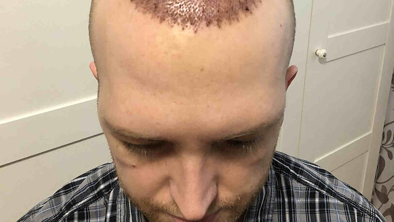 Erster Tag nach der Haartransplantation. Erster Tag nach der Haartransplantation.