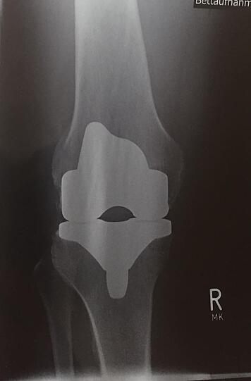Hugo Bachmaier hat jetzt ein Titan-Knie