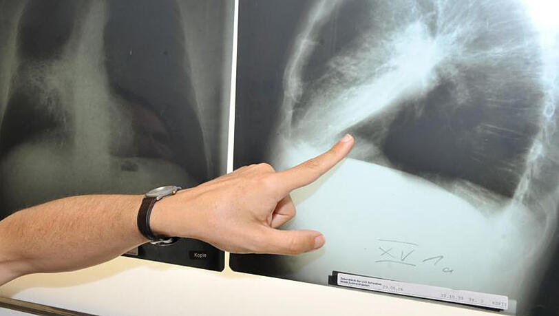 Röntgenbild einer mit Krebs befallenen Lunge im Klinikum der Universität München. Röntgenbild einer mit Krebs befallenen Lunge im Klinikum der Universität München.