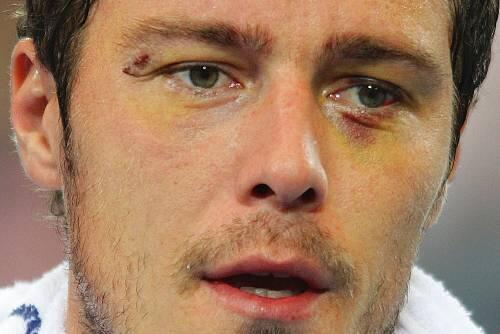 Schrammen von einer Schlägerei in der Disco: Marat Safin.