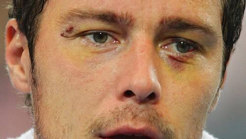 Schrammen von einer Schlägerei in der Disco: Marat Safin. Schrammen von einer Schlägerei in der Disco: Marat Safin.