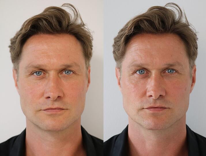 Haartransplantation sowie Eigenfettunterspritzung im Gesicht - Model und Schauspieler Nico Schwanz steht dazu, dass nicht alles Natur ist. Im Juli 2020 ließ er sich Hyaluron in das Kinn spritzen, um maskuliner zu wirken. Das Foto zeigt ihn vor und nach dem Eingriff.