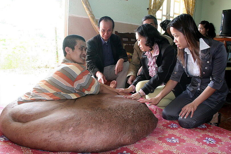 Der krebskranke Vietnamese Nguyen Duy Hai in seinem Haus in Da Lat (Vietnam). Er zeigt seinen 90 Kilogramm schweren Tumor am Bein, der in Vietnam von einem amerikanischen Spezialisten operiert wird.