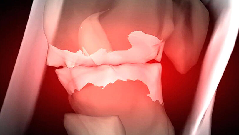 Was Ist Schlimmer Arthrose Oder Arthritis