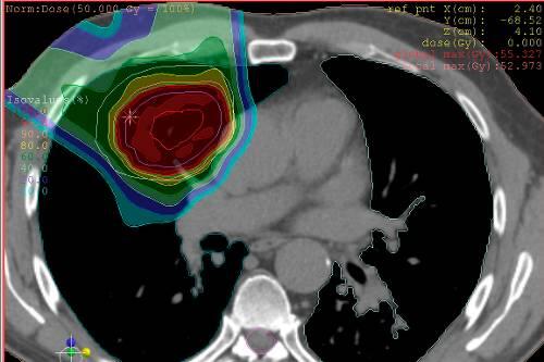Der Vorteil der Protonen-Therapie: Die Bestrahlung trifft mit hoher Dosis exakt den Tumor (rot) &ndash; gesundes Gewebe wird kaum, der linke Lungenflügel gar nicht belastet.
